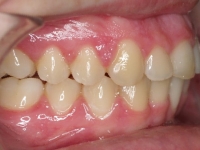 14-05--075-Right Bite-06092017