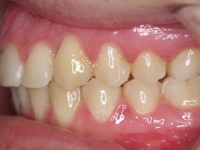 14-06--074-Left Bite-06092017