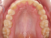 14-07--076-Upper Occlusal-06092017