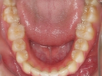 14-08--077-Lower Occlusal-06092017