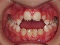 02-04-Imagen-12-073-Anterior-Bite-20102011