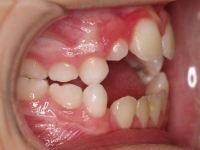 02-05-Imagen-13-075-Right-Bite-20102011