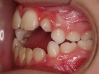 02-06-Imagen-14-074-Left-Bite-20102011