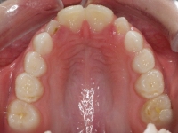 02-07-Radiografía-076-Upper-Occlusal-20102011