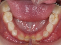 02-08-Imagen-16-077-Lower-Occlusal-20102011