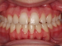 14-04-Imagen-15-073-Anterior-Bite-23052019