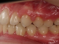 14-06-Imagen-17-074-Left-Bite-23052019