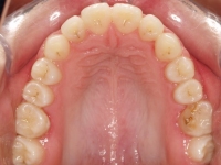 14-07-Imagen-18-076-Upper-Occlusal-23052019