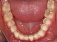 14-08-Imagen-19-077-Lower-Occlusal-23052019