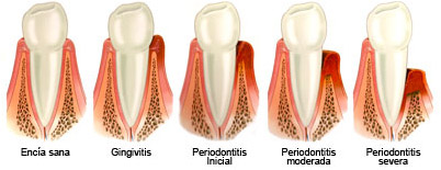Periodontitis-2
